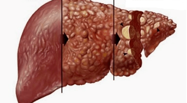 effetti nocivi dell'alcol sul fegato umano